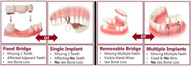 dental bridges chester springs pa