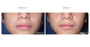 lip reduction y lip surgery