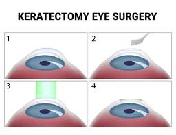 Keratectomy In Nyc Vitreous Retina