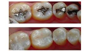 آمالگام آری یا خیر ایمپلنت دندان در