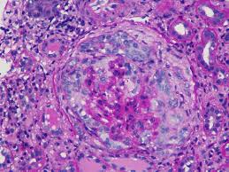 Temp Cering Of Antiglomerular