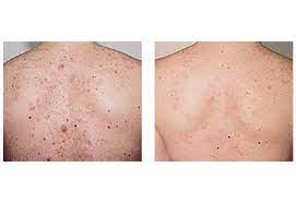 laser acne treatment vbeam