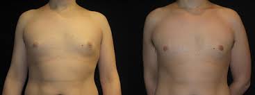 gynecomastia before and after pictures
