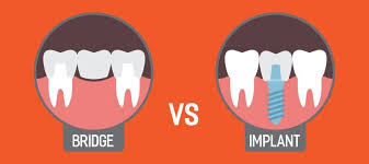 dental implants vs bridges the great