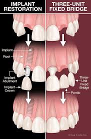 dental implants vs bridgework dear