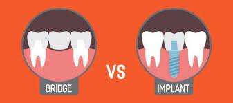 dental implants vs bridges how to know