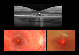 retinal burns from laser pointers a