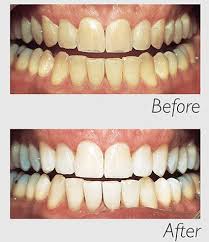 philips zoom whitening at smile forever