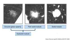 Lung Cancer Screening What Is A Nodule