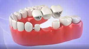 dental implants or dental bridges