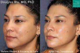 vbeam perfecta laser skin treatment