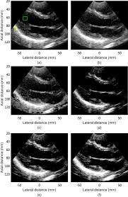 cal ultrasound imaging