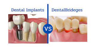 dental bridge vs implant sitti