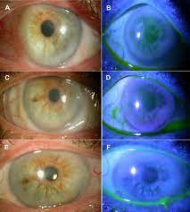 Epithelial Basement Membrane Dystrophy