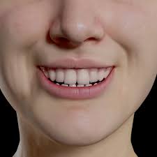 corrective treatment for gummy smile