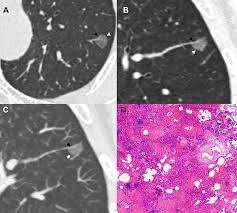 Pulmonary Benign Ground Glass Nodules