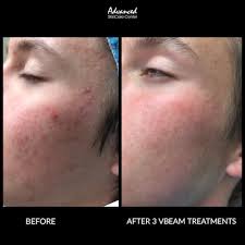 laser skin rejuvenation before and