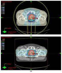 proton therapy for prostate cancer