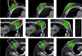 tumour bed boost in t cancer