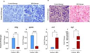 The Pcos Nafld Multidisease Phenotype