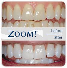 zoom teeth whitening bangkok et
