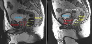 during radiotherapy for prostate cancer