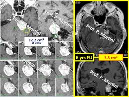 stereotactic radiosurgery pietro mortini