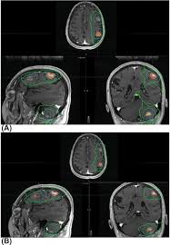 technologies for srs and sbrt delivery