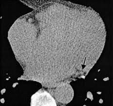 spiral and electron beam tomography