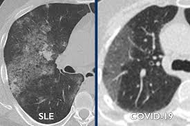 Covid 19 Diffeial Diagnosis