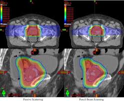 proton beam therapy for the treatment