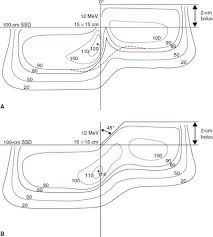 electron beam therapy dosimetry