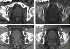 offline image guided radiation therapy