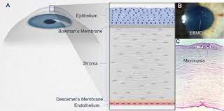 Epithelial Basement Membrane Dystrophy