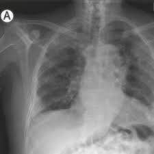 Pneumonia And Ground Glass Opacities