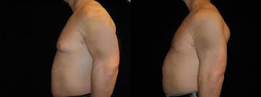 gynecomastia before and after pictures
