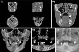 cone beam computed tomography findings