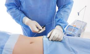 laser liposuction smartlipo is it