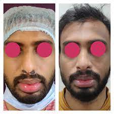 lip reduction surgery cost in bangalore