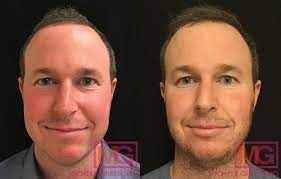 vbeam before after photos dr