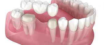 dental implant or a dental bridge