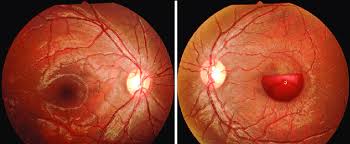 a fundus photograph of normal od b