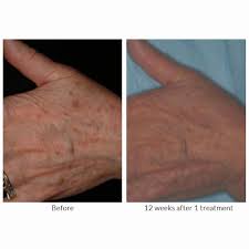 vbeam laser treatment