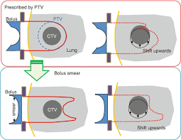 treatment planning system for proton