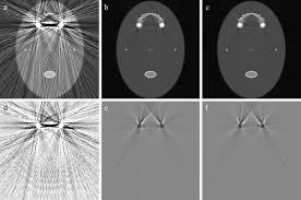 a metal artifact reduction method for a