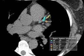 ct calcium scoring becoming a key risk