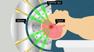 stereotactic therapy best for brain