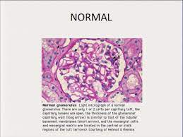 Glomerular Disease Part I Flashcards