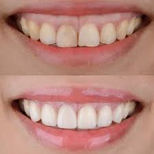 gummy smile treatment in abad