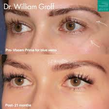 vbeam prima vascular laser treatment